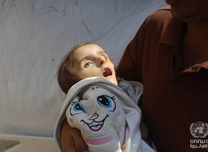 A 4-year-old Palestinian girl, lost her life due to malnutrition and lack of treatment due to the war on Gaza