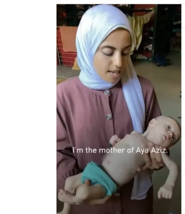 Mother holding malnourished baby